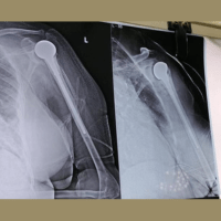 Arthroplasty