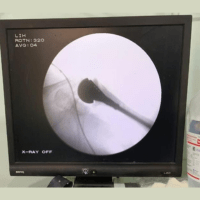 Successful Arthroplasty