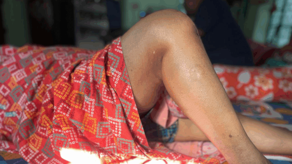 Knee Replacement recovery by Dr Arindam Majumdar