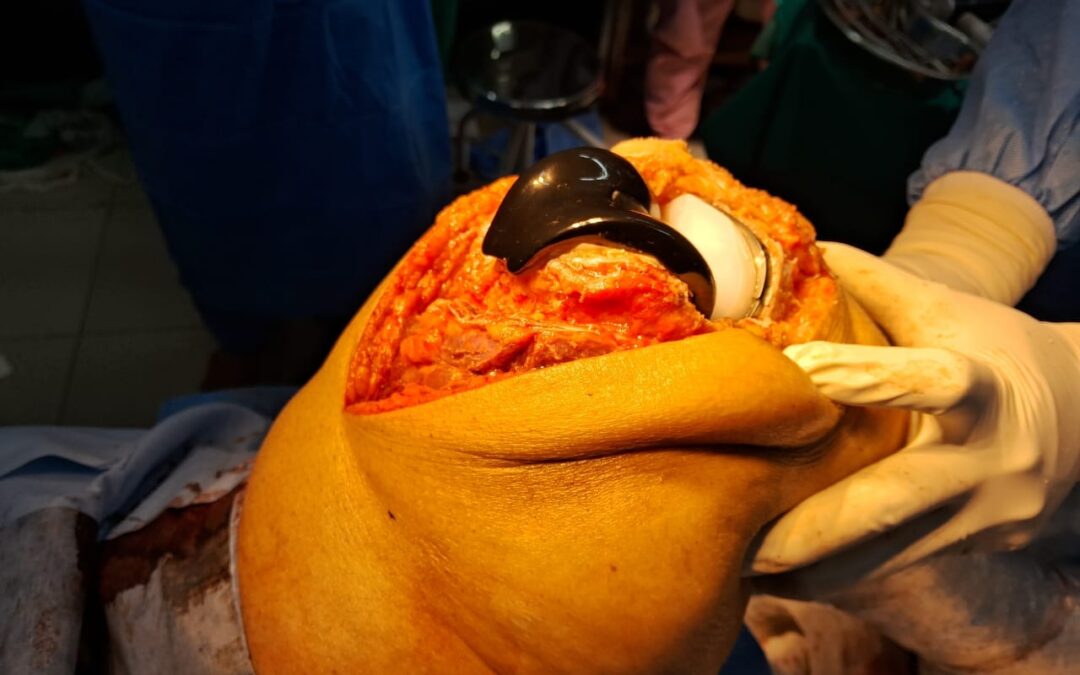 Knee replacement surgery